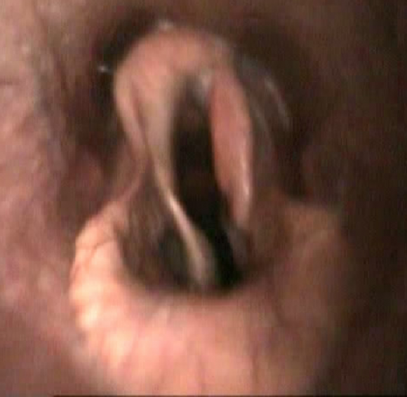 Abbildung eines Kehlkopfes Grad 4 (vollständige Lähmung des linken Stellknorpels)